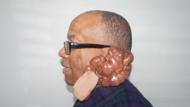 بالصورة خطأ حلاق يسبب ورماً وزنه عشرون كجم لزبون