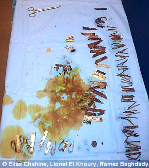 بالصورة .. استخراج أكثر من 100 قطعة معدنية من بطن خمسيني 2 %D8%A7%D8%B3%D8%AA%D8%AE%D8%B1%D8%A7%D8%AC %D8%A3%D9%83%D8%AB%D8%B1 %D9%85%D9%86 100 %D9%82%D8%B7%D8%B9%D8%A9 %D9%85%D8%B9%D8%AF%D9%86%D9%8A%D8%A9 %D9%85%D9%86 %D8%A8%D8%B7%D9%86 %D8%AE%D9%85%D8%B3%D9%8A%D9%86%D9%8A