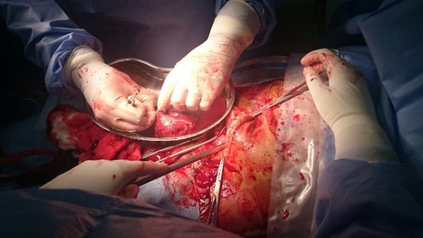 إنقاذ ثلاثينية تعاني حملاً خارج الرحم بمستشفى خميس مشيط للولادة