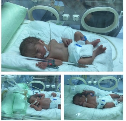 ولادة 3 توائم لسيدة سورية بمستشفى الإمام عبدالرحمن الفيصل