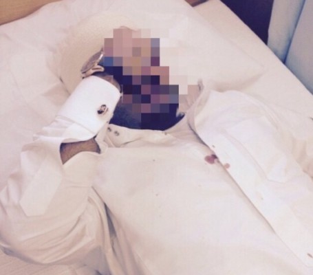 إصابات في الوجه لمعلم مُعتدى عليه عند باب المدرسة في تبوك