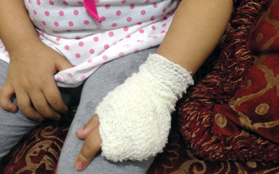طفلة تفقد ثلاثة أصابع من يدها بعد وضعها في فرامة اللحم