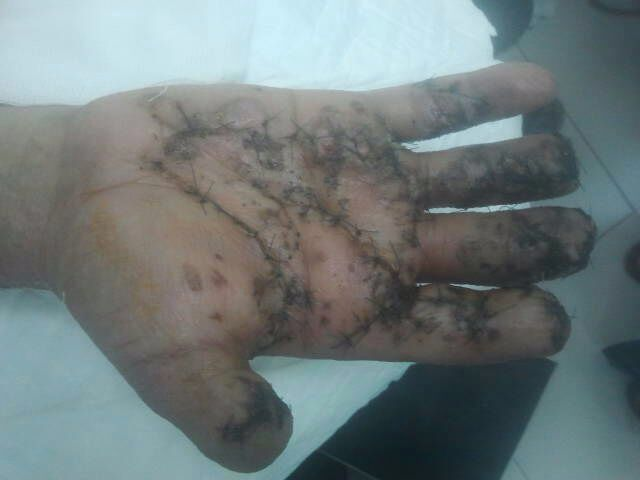 فريق طبي بمستشفى الملك خالد ينقذ أصابع يد مريض من البتر