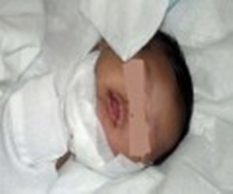 جمعية زمزم تخلص طفلاً من ورم احتل وجهه كاملا