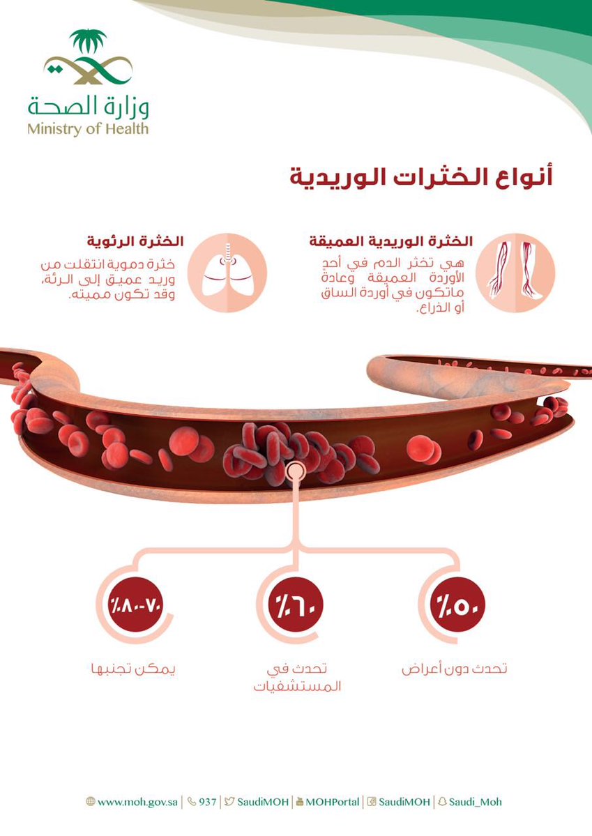 الصحة تحذر من الخثرات الوريدية: 50 % منها تحدث دون أي أعراض