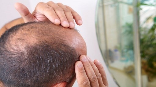 استنساخ الشعر.. طريقة جديدة لعلاج مشكلة الصلع