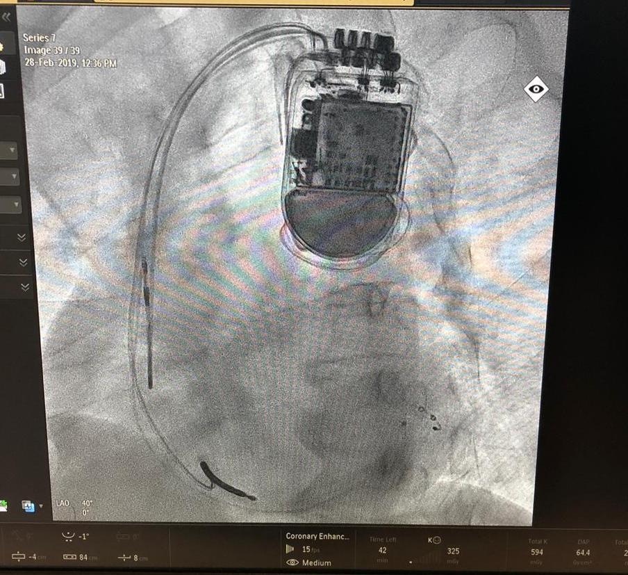 تركيب صاعق لتنظيم ضربات القلب لمريض بمستشفى الأمير محمد بن عبدالعزيز
