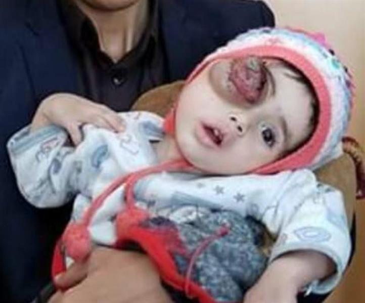 الأمير محمد بن سلمان يوجه بعلاج الطفل اليمني المصاب بورم في عينه على نفقته الخاصة