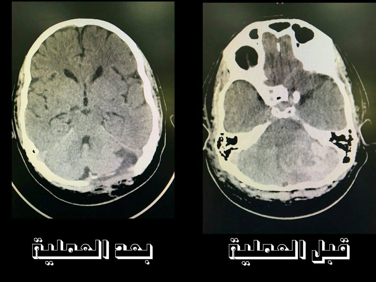 إنقاذ حياة ثلاثيني يعاني من ورم ونزيف بالمخ في جدة