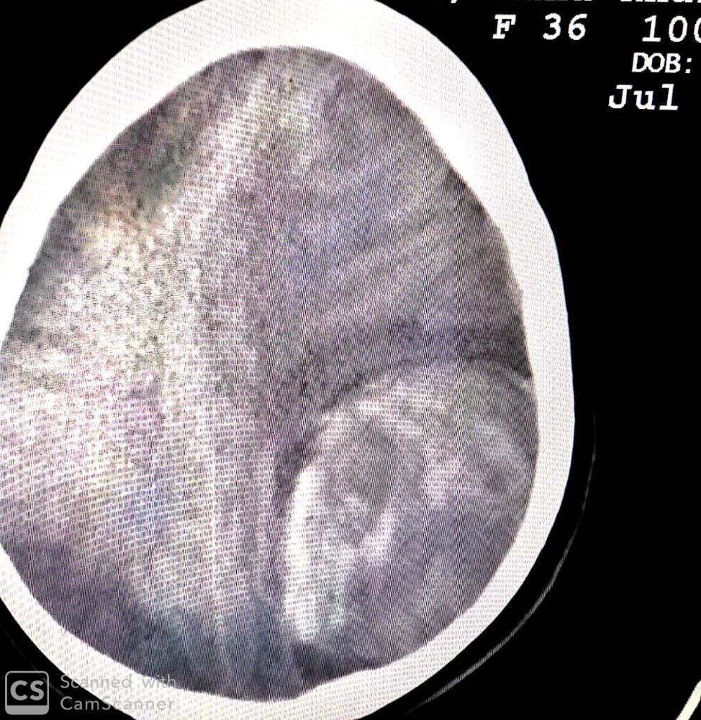 جراحة صعبة في المخ تنقذ حاملاً بالشهر الـ8
