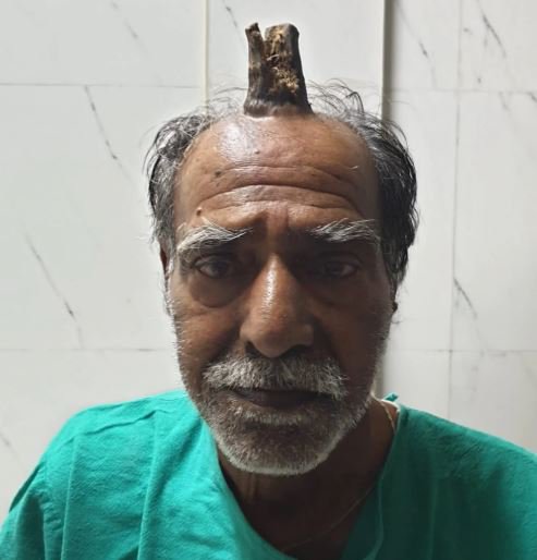صور مرعبة.. قرن الشيطان ينمو في رأس رجل هندي