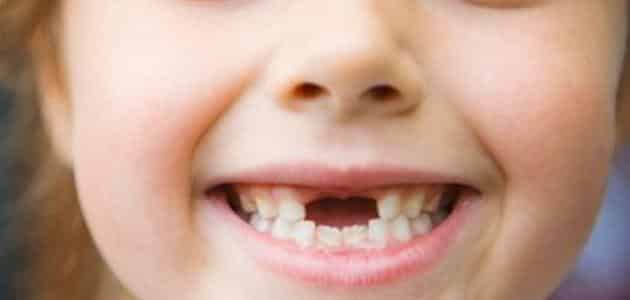 متى يفقد الأطفال أسنانهم اللبنية ؟