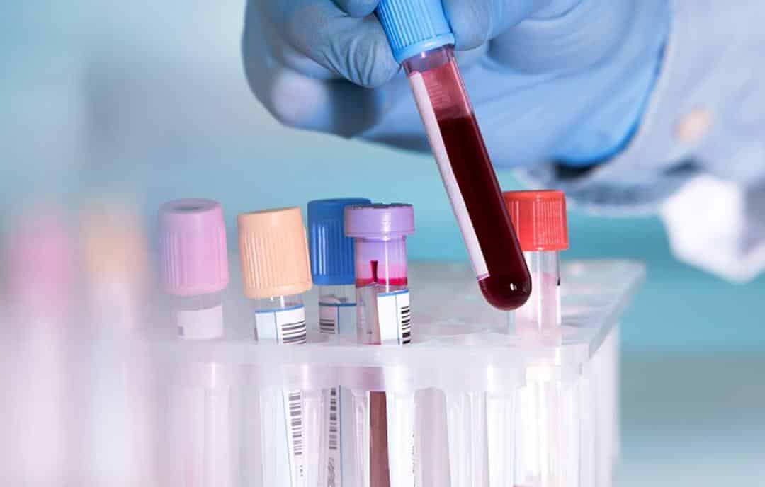 هل ينجح اختبار الدم لكشف ٥٠ نوعًا من السرطان ؟ متخصص يرد