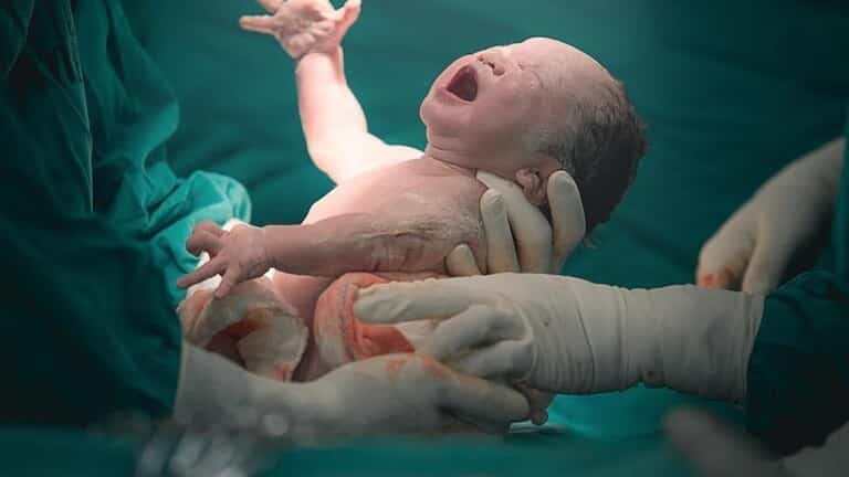 ولادة نادرة لطفل يحمل توأمه في بطنه