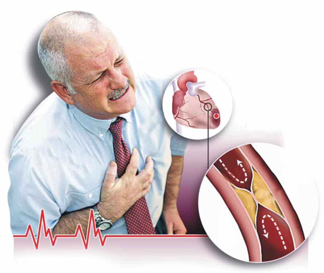 10 عوامل خطرة تمهد لتصلب الشرايين