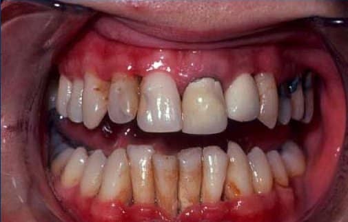 مواد سامة في التدخين تهدد “مينا” الأسنان