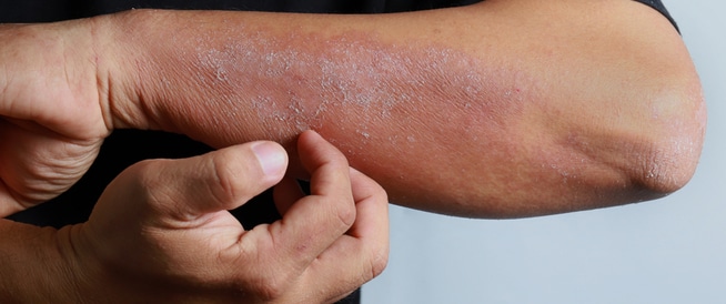 5 أعراض جلدية مرتبطة بعدوى فيروس كورونا
