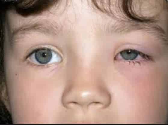 استشاري لـ”المواطن”: لا تتجاهلوا مشاكل عيون الأطفال
