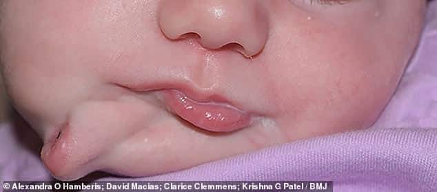 طفلة تولد بحالة ثنائية الوجه.. تمتلك فمين كاملين بالشفاه واللسان والأسنان
