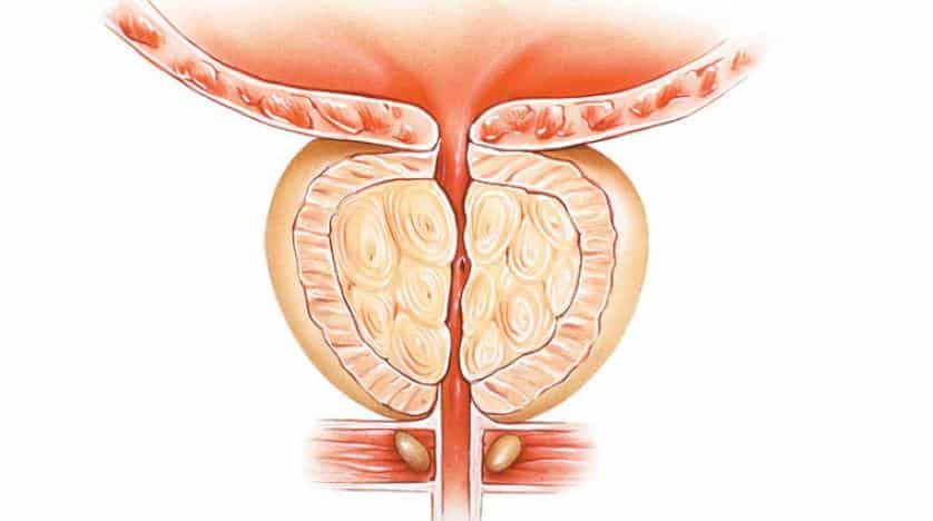 أعراض سرطان البروستات وطرق الوقاية منه