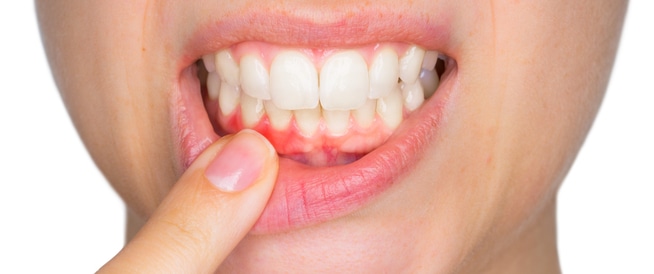 استشارية لـ”المواطن”: نزيف اللثة علامة غير صحية لأسنانك
