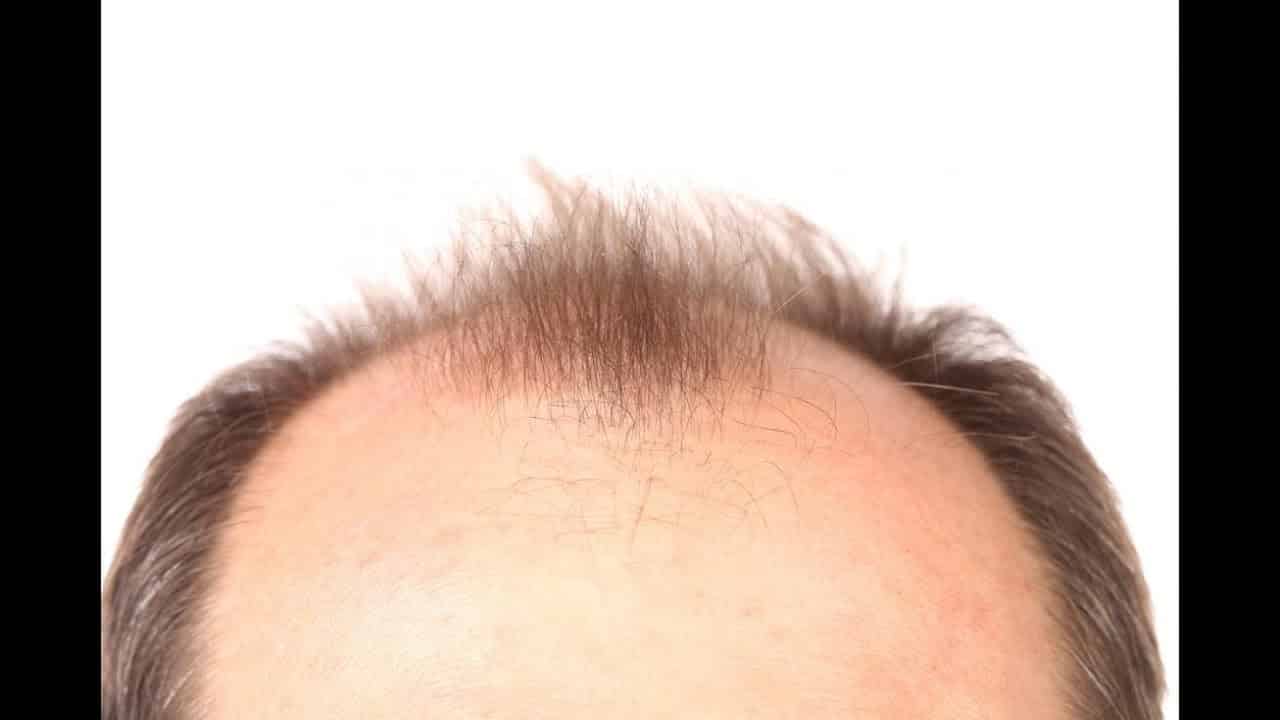اكتشاف يعزز نمو الشعر ويسهل علاج الصلع