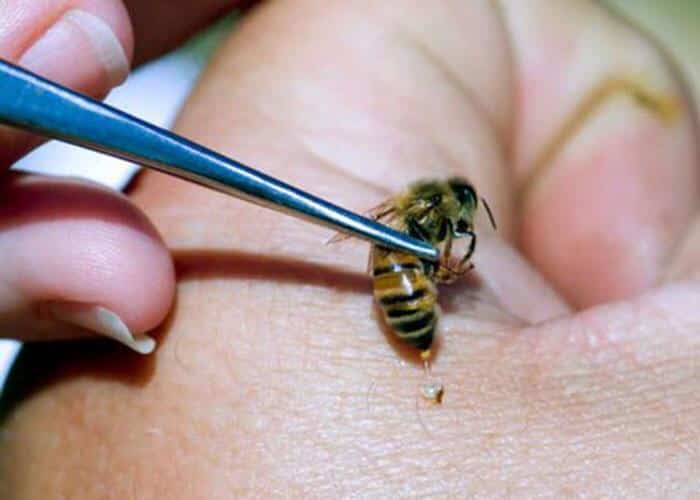 استشاري يكشف لـ”المواطن” سبب عدم انتشار العلاج بلسعات النحل