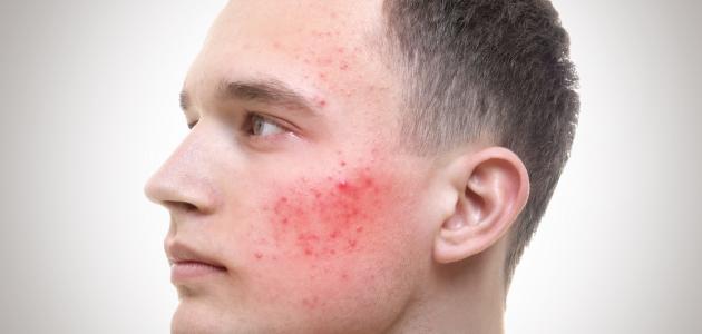 ما أسباب ظهور حبوب حمراء في الجسم مع حكة وأفضل الطرق لعلاجها