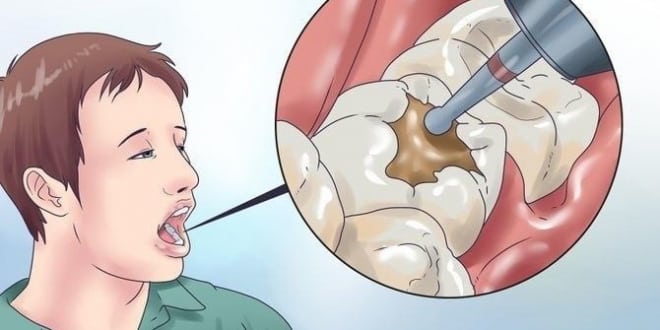 ما هو سبب ألم الأسنان بعد الحشو؟