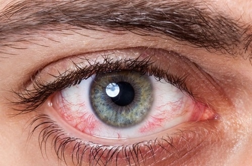 صورة أسباب جفاف العين وأعراضها وطرق العلاج