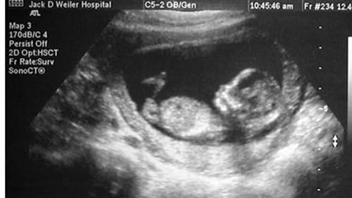 भ्रूण का लिंग स्पष्ट रूप से कब निर्धारित किया जाता है, चाहे वह लड़का हो या लड़की?