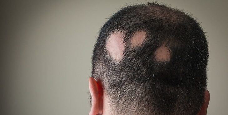 ما هو علاج ثعلبة الشعر