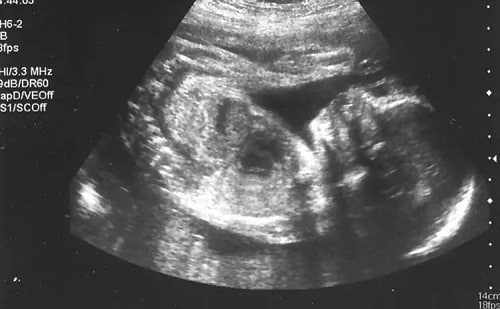 الشهر الثالث من الحمل وجنس الجنين