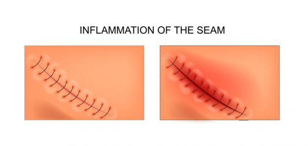 كيف أعرف أن جرح العملية القيصرية ملتهب وما هي طرق العلاج