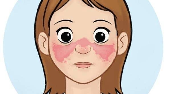 Ù‡Ù„ Ù…Ø±Ø¶ Ø§Ù„Ø°Ø¦Ø¨Ø© Ø§Ù„Ø­Ù…Ø±Ø§Ø¡ ÙŠØ³Ø¨Ø¨ Ø§Ù„ÙˆÙØ§Ø© ÙˆÙ…Ø§ Ù‡ÙŠ Ø·Ø±Ù‚ Ø¹Ù„Ø§Ø¬Ù‡
