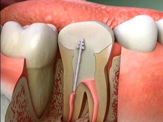 علاج التهاب عصب الاسنان بالاعشاب