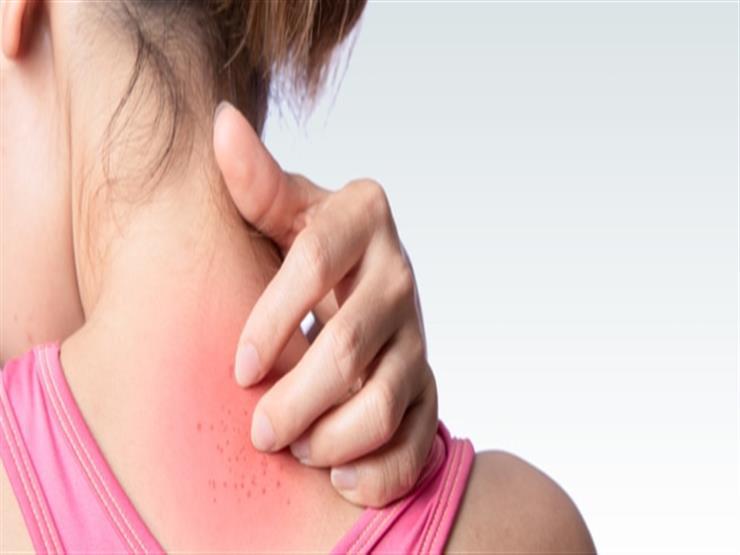 أعراض جلدية خطيرة تُنبئ بالإصابة بفيروس كورونا