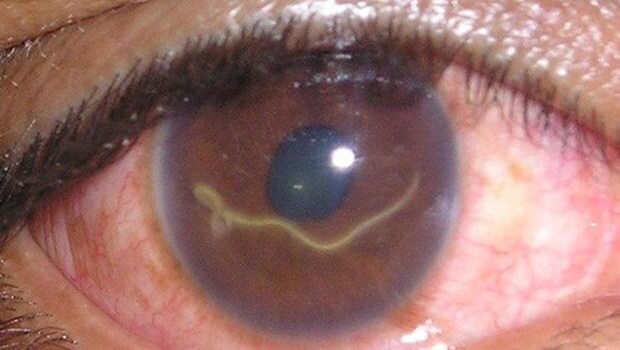أعراض دخول الديدان في العين وطرق الوقاية منها