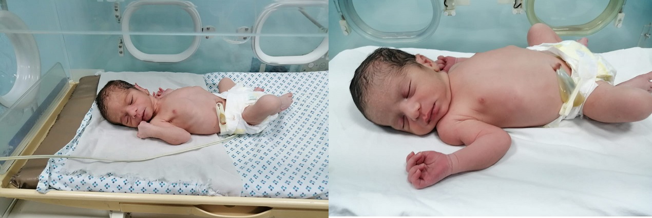 ولادة توأم لأم مصابة بفيروس كورونا لأول مرة في مصر