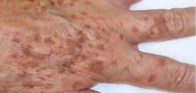 أسباب ظهور بقع بنية على الجلد