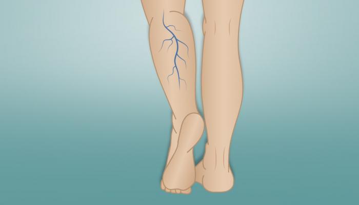 اسباب مرض دوالي الساق