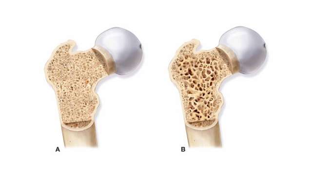 الفرق بين ترقق العظام وهشاشة العظام