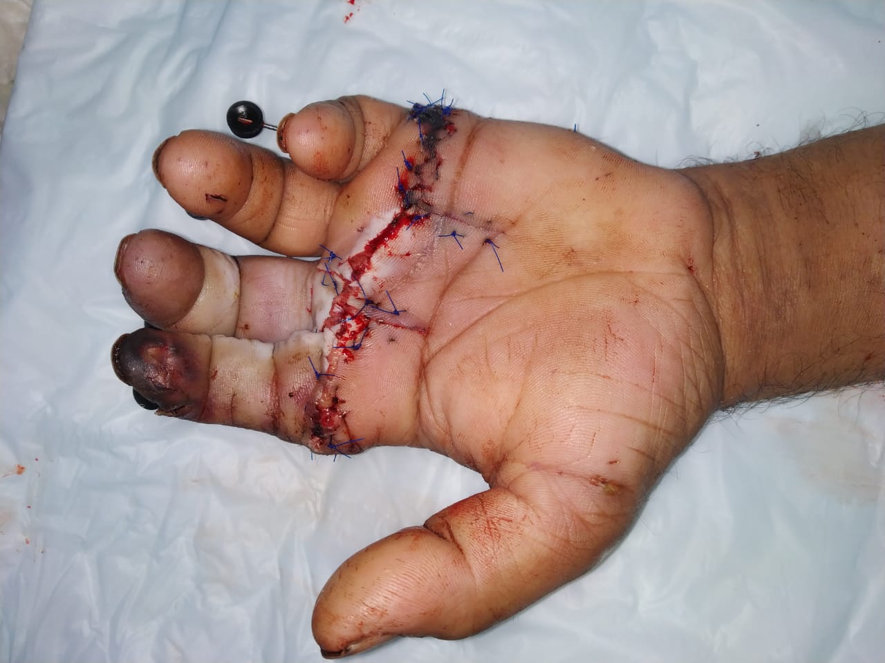 سعود الطبية: إنقاذ أربعيني من بتر أربعة أصابع