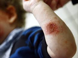 علامات مبكرة تدل على إصابة الأطفال بالصدفية