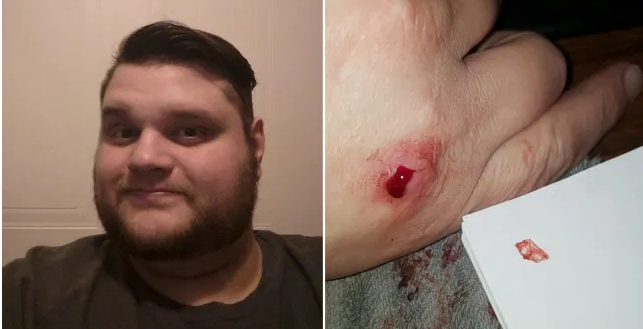 أمريكي يخرج من يده قطعة زجاج صدفة ويكتشفها بعد 4 سنوات
