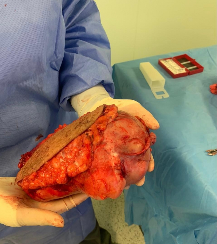 تخصصي تبوك ينجح في استئصال ورم حميد بوزن 2150 جرامًا صحيفة المواطن