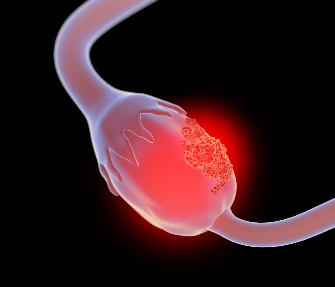 إنجاز كبير في عالم الطب.. اختراع حبوب لعلاج سرطان المبيض