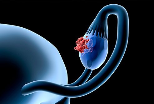 إنجاز كبير في عالم الطب.. اختراع حبوب لعلاج سرطان المبيض