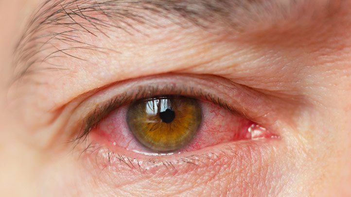 كيفية التخلص من جفاف العين بشكل طبيعي