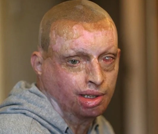 دمرت حياته.. امرأة تسكب مادة حارقة على وجه زوجها أثناء نومه